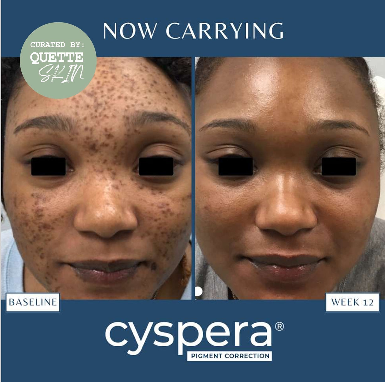 Cyspera Intensive Duo with .75% Pure Liquid Retinol